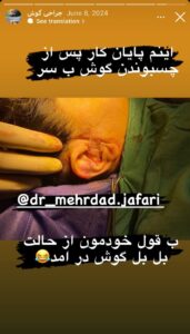 نمونه کار اتوپلاستی (جراحی گوش) دکتر جعفری در ساری