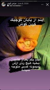 نمونه کار اتوپلاستی (جراحی گوش) دکتر جعفری در ساری
