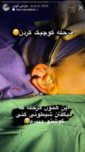 نمونه کار اتوپلاستی (جراحی گوش) دکتر جعفری در ساری