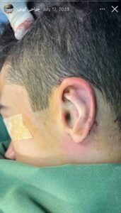 نمونه کار اتوپلاستی (جراحی گوش) دکتر جعفری در ساری