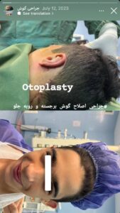 نمونه کار اتوپلاستی (جراحی گوش) دکتر جعفری در ساری