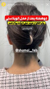 نمونه کار اتوپلاستی (جراحی گوش) دکتر محرابی در ساری