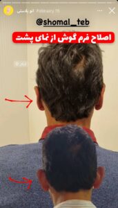 نمونه کار اتوپلاستی (جراحی گوش) دکتر محرابی در ساری