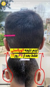 نمونه کار اتوپلاستی (جراحی گوش) دکتر محرابی در ساری