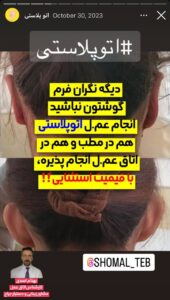 نمونه کار اتوپلاستی (جراحی گوش) دکتر محرابی در ساری