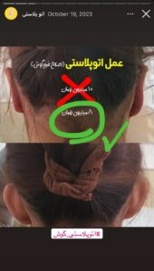 نمونه کار اتوپلاستی (جراحی گوش) دکتر محرابی در ساری