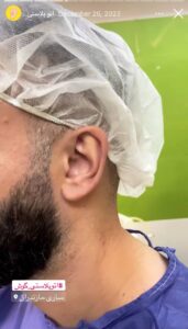 نمونه کار اتوپلاستی (جراحی گوش) دکتر محرابی در ساری