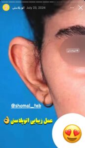 نمونه کار اتوپلاستی (جراحی گوش) دکتر محرابی در ساری