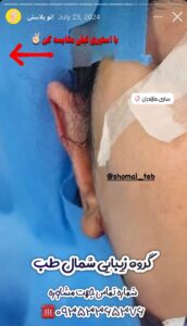 نمونه کار اتوپلاستی (جراحی گوش) دکتر محرابی در ساری