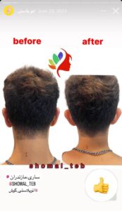 نمونه کار اتوپلاستی (جراحی گوش) دکتر محرابی در ساری