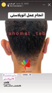 نمونه کار اتوپلاستی (جراحی گوش) دکتر محرابی در ساری