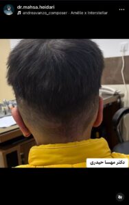 نمونه کار اتوپلاستی (جراحی گوش) دکتر حیدری در ساری