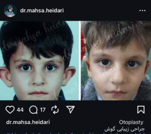 نمونه کار اتوپلاستی (جراحی گوش) دکتر حیدری در ساری