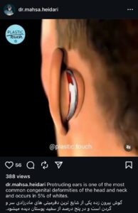 نمونه کار اتوپلاستی (جراحی گوش) دکتر حیدری در ساری