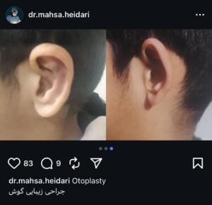 نمونه کار اتوپلاستی (جراحی گوش) دکتر حیدری در ساری