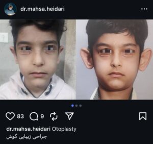 نمونه کار اتوپلاستی (جراحی گوش) دکتر حیدری در ساری