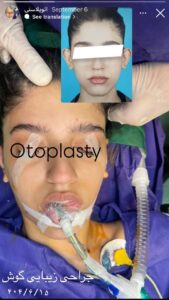 نمونه کار اتوپلاستی (جراحی گوش) دکتر قریشی