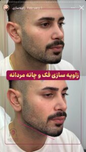 نمونه کار زاویه سازی صورت کلینیک الگانت