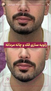 نمونه کار زاویه سازی صورت کلینیک الگانت