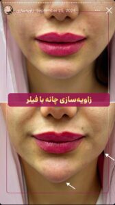 نمونه کار زاویه سازی صورت کلینیک الگانت