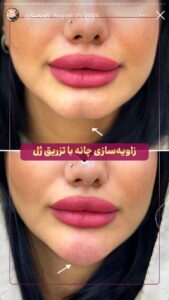 نمونه کار زاویه سازی صورت کلینیک الگانت