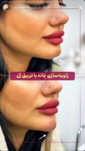 نمونه کار زاویه سازی صورت کلینیک الگانت