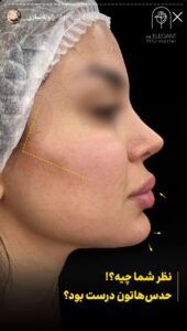 نمونه کار زاویه سازی صورت کلینیک الگانت