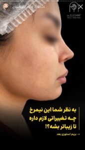 نمونه کار زاویه سازی صورت کلینیک الگانت