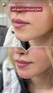 نمونه کار زاویه سازی صورت کلینیک الگانت