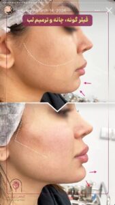 نمونه کار زاویه سازی صورت کلینیک الگانت