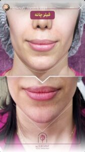 نمونه کار زاویه سازی صورت کلینیک الگانت