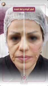 نمونه کار زاویه سازی صورت کلینیک الگانت