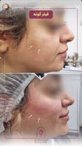 نمونه کار زاویه سازی صورت کلینیک الگانت