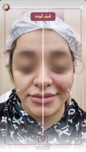 نمونه کار زاویه سازی صورت کلینیک الگانت