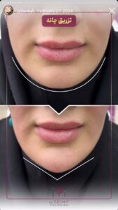 نمونه کار زاویه سازی صورت کلینیک الگانت