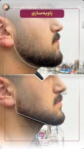 نمونه کار زاویه سازی صورت کلینیک الگانت