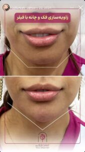 نمونه کار زاویه سازی صورت کلینیک الگانت