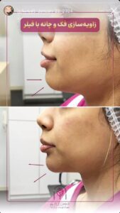 نمونه کار زاویه سازی صورت کلینیک الگانت