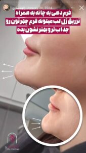 نمونه کار زاویه سازی صورت کلینیک الگانت