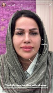 نمونه کار زاویه سازی صورت کلینیک الگانت