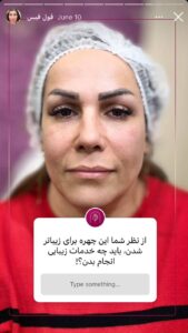 نمونه کار زاویه سازی صورت کلینیک الگانت