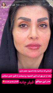 نمونه کار زاویه سازی صورت کلینیک الگانت