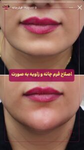 نمونه کار زاویه سازی صورت کلینیک الگانت