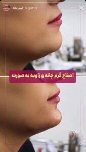 نمونه کار زاویه سازی صورت کلینیک الگانت