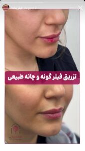 نمونه کار زاویه سازی صورت کلینیک الگانت