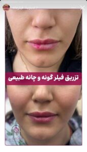 نمونه کار زاویه سازی صورت کلینیک الگانت