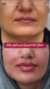 نمونه کار زاویه سازی صورت کلینیک الگانت