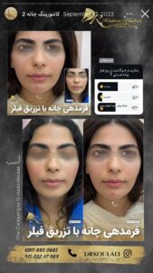 نمونه کار زاویه سازی صورت دکتر اسلامی در ساری