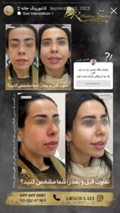 نمونه کار زاویه سازی صورت دکتر اسلامی در ساری