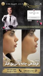 نمونه کار زاویه سازی صورت دکتر اسلامی در ساری